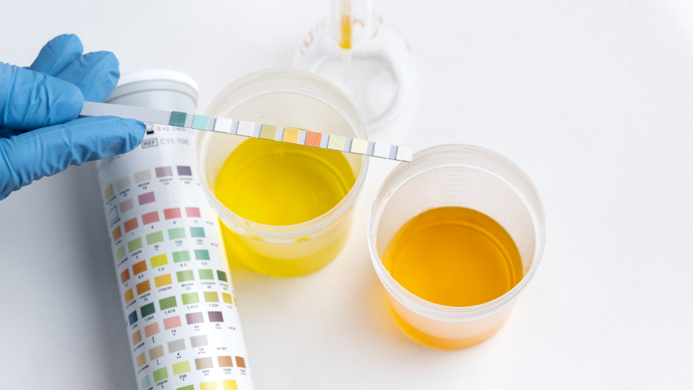 Entenda o que é a Glomerulonefrite Membranoproliferativa (GNMP), seus sintomas, causas, diagnóstico e opções de tratamento para preservar a função renal.